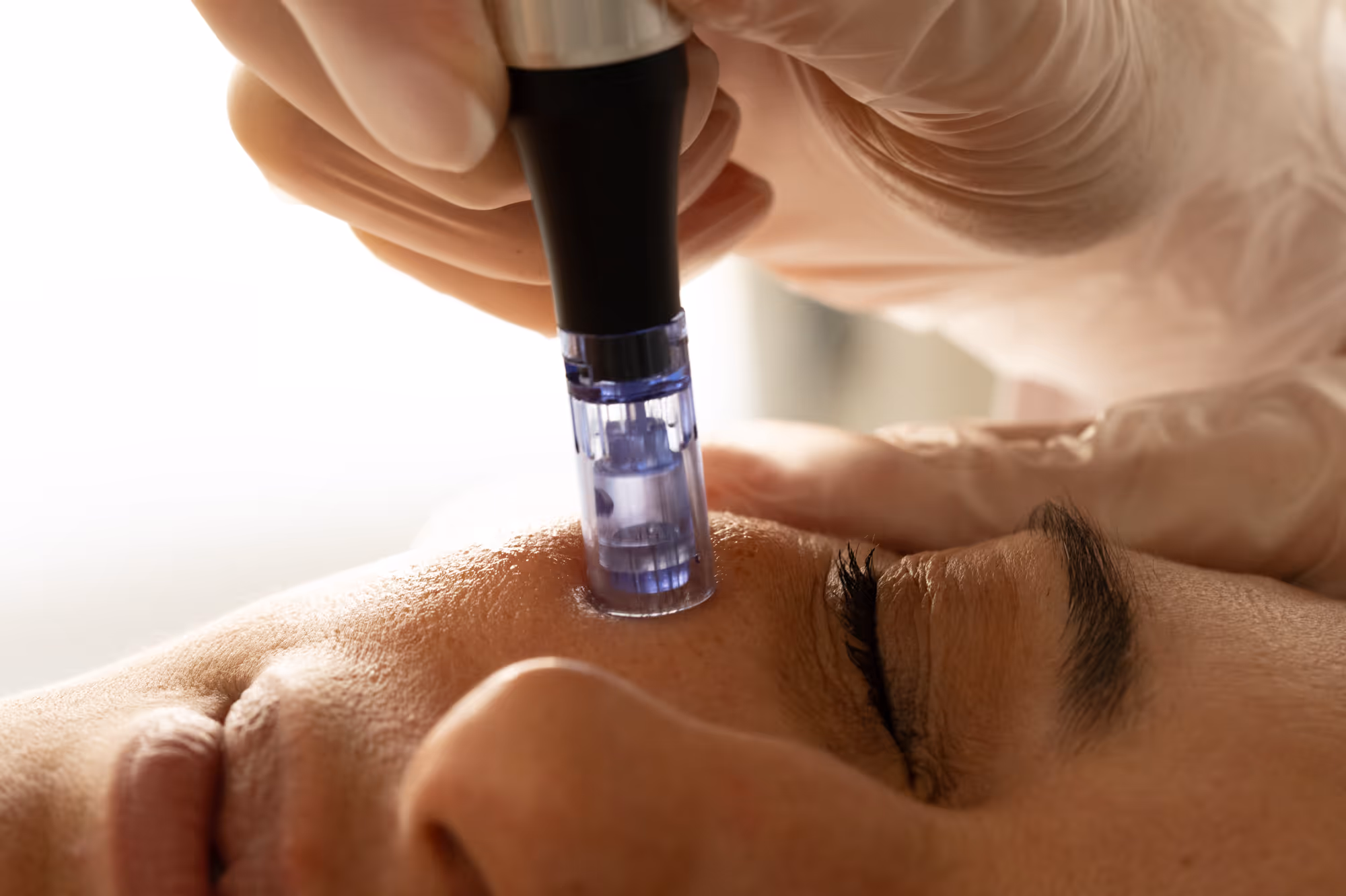 Microneedling with Exosomes Skin Booster.