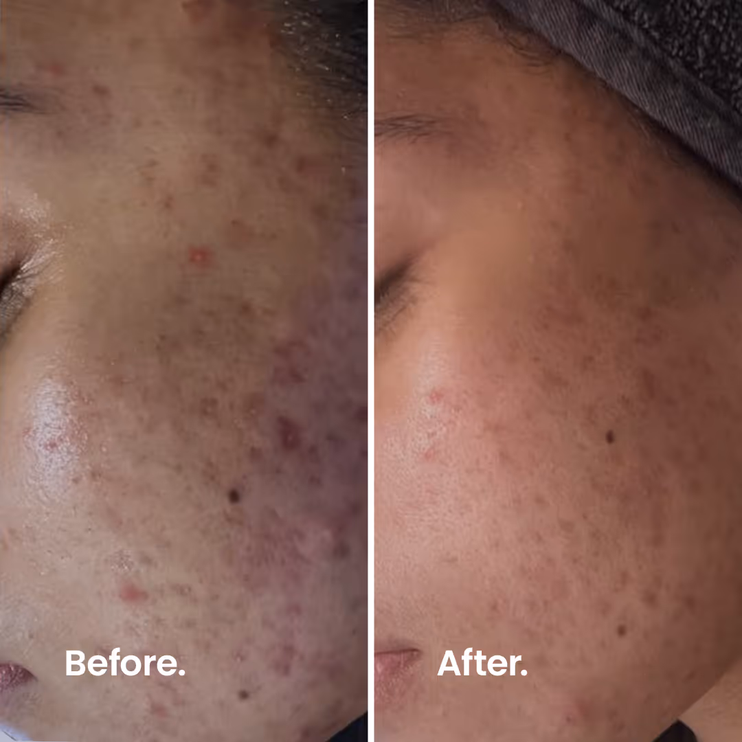 Before & After. IPL.