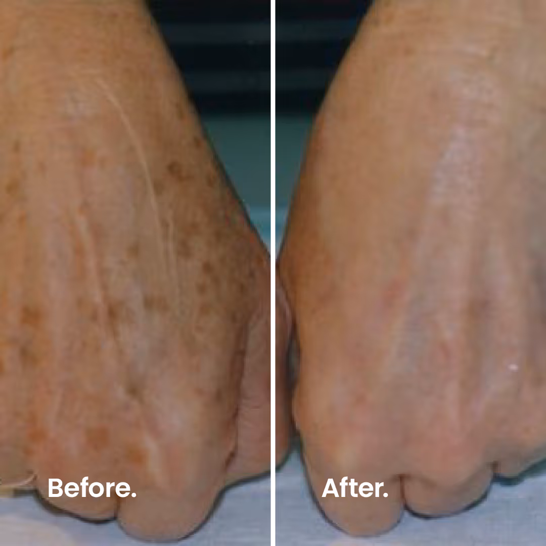Before & After. IPL.