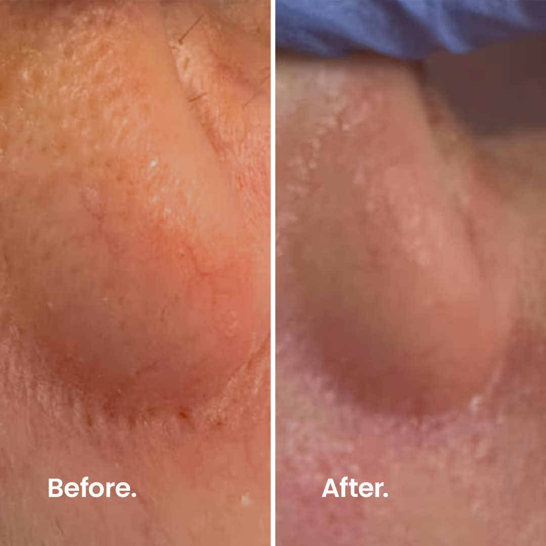 Before & After. IPL.