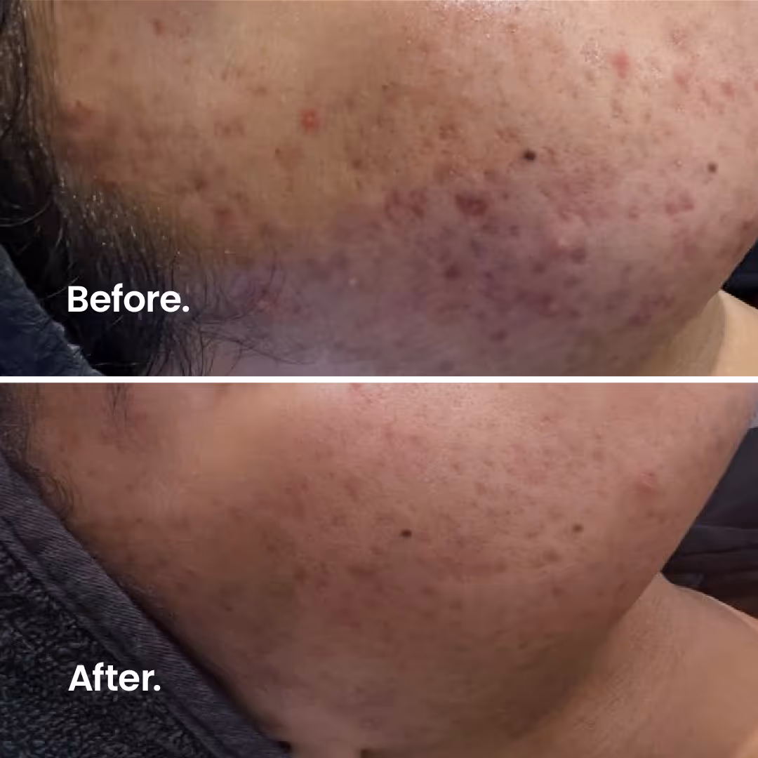 Before & After. Microneedling.