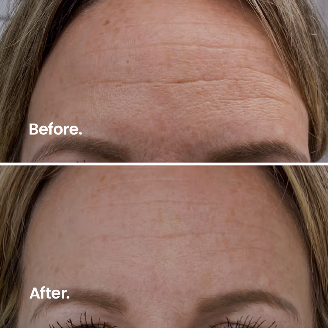 Before & After. Microneedling.
