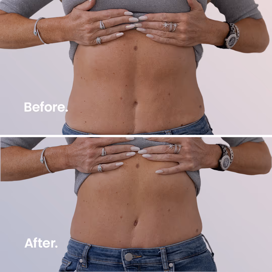 Before & After. ULTRAcel Q+ HIFU Body.