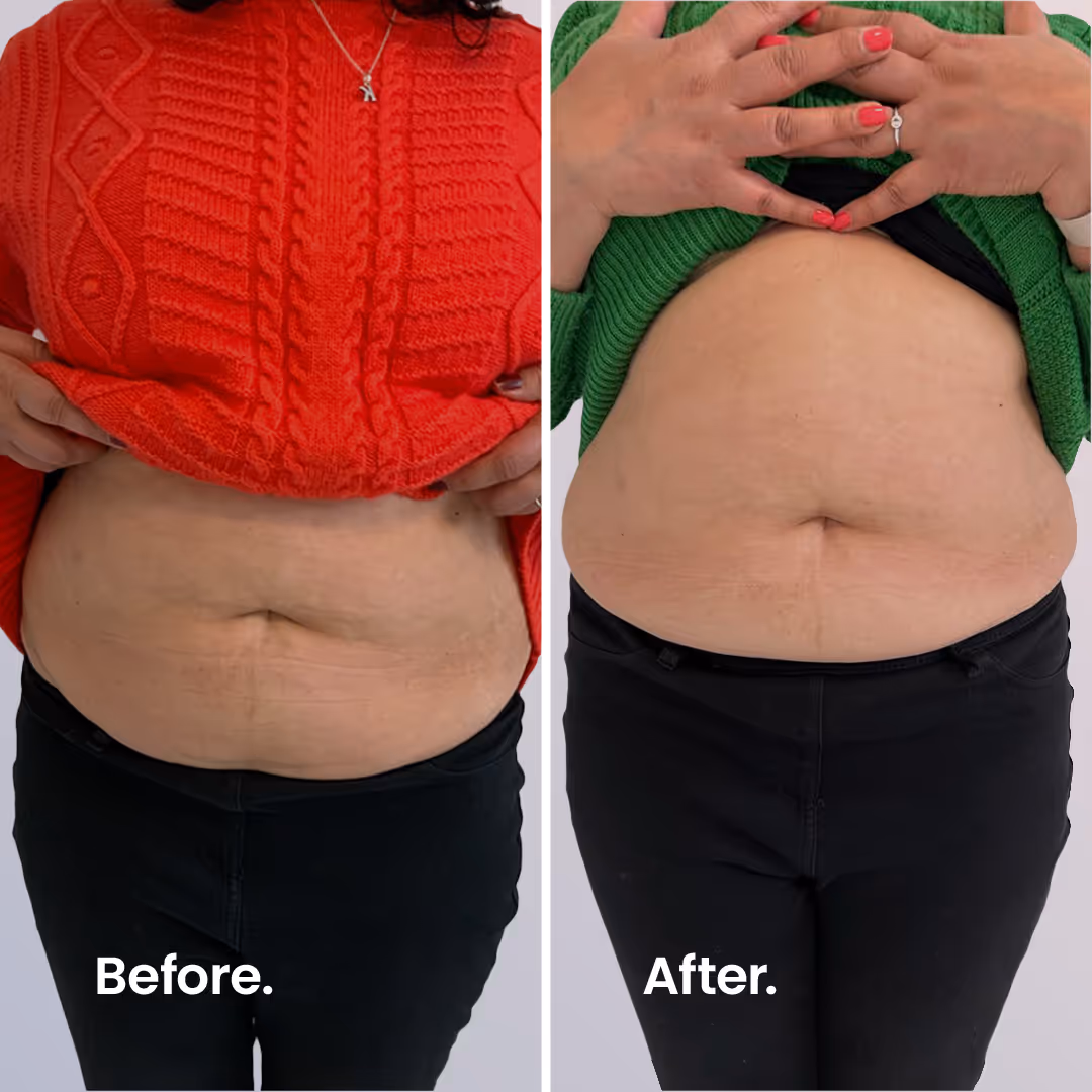 Before & After. ULTRAcel Q+ HIFU Body.