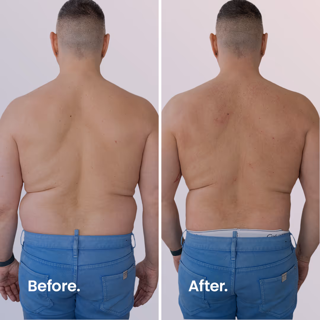 Before & After. ULTRAcel Q+ HIFU Body.