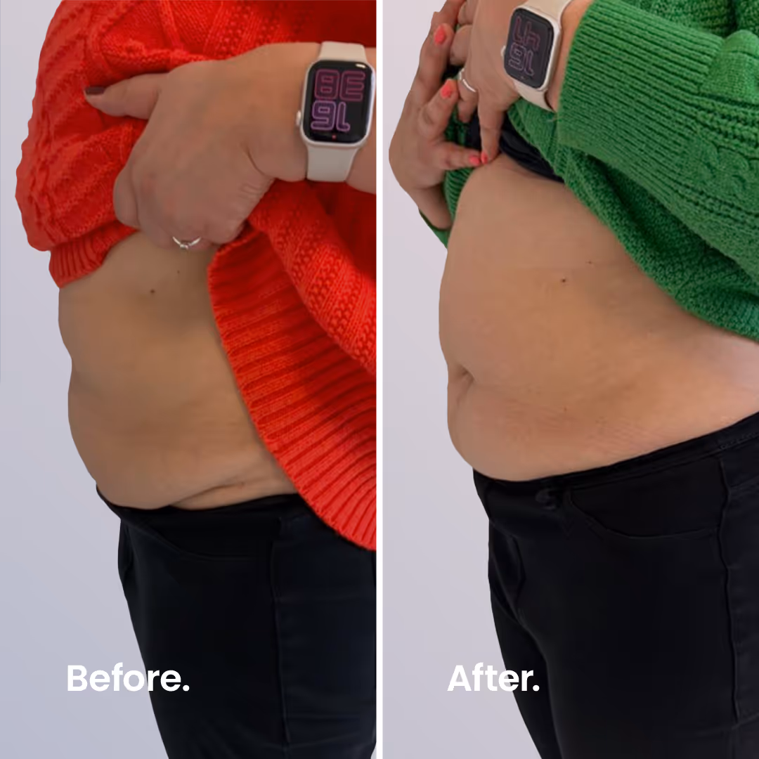 Before & After. ULTRAcel Q+ HIFU Body.