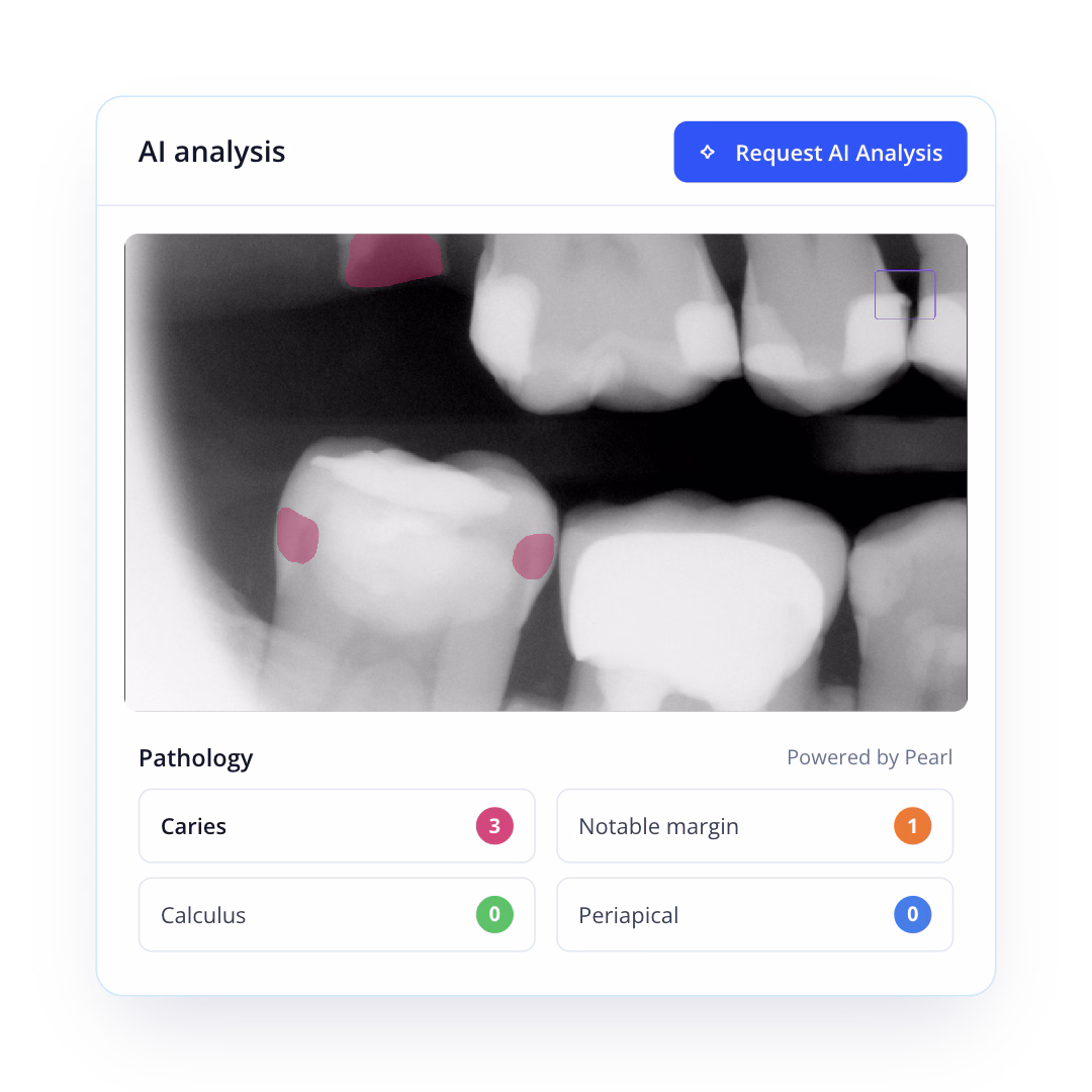 Archy dental digital imaging software running Pearl AI analysis to detect caries and margins on radiograph views.