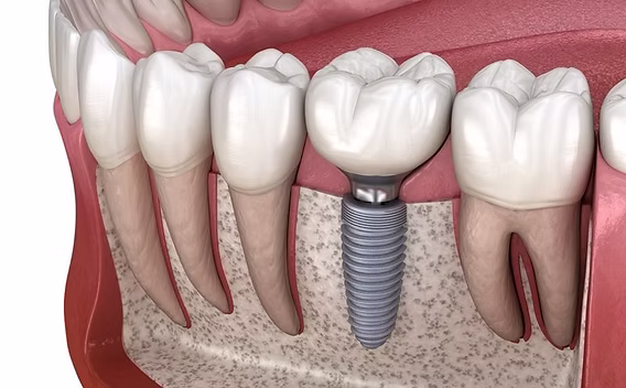 Dental implant and restoration