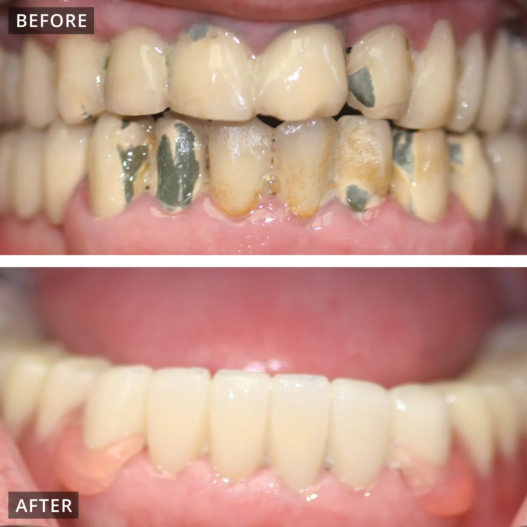 Lower broken and missing teeth:  crowns and partial denture