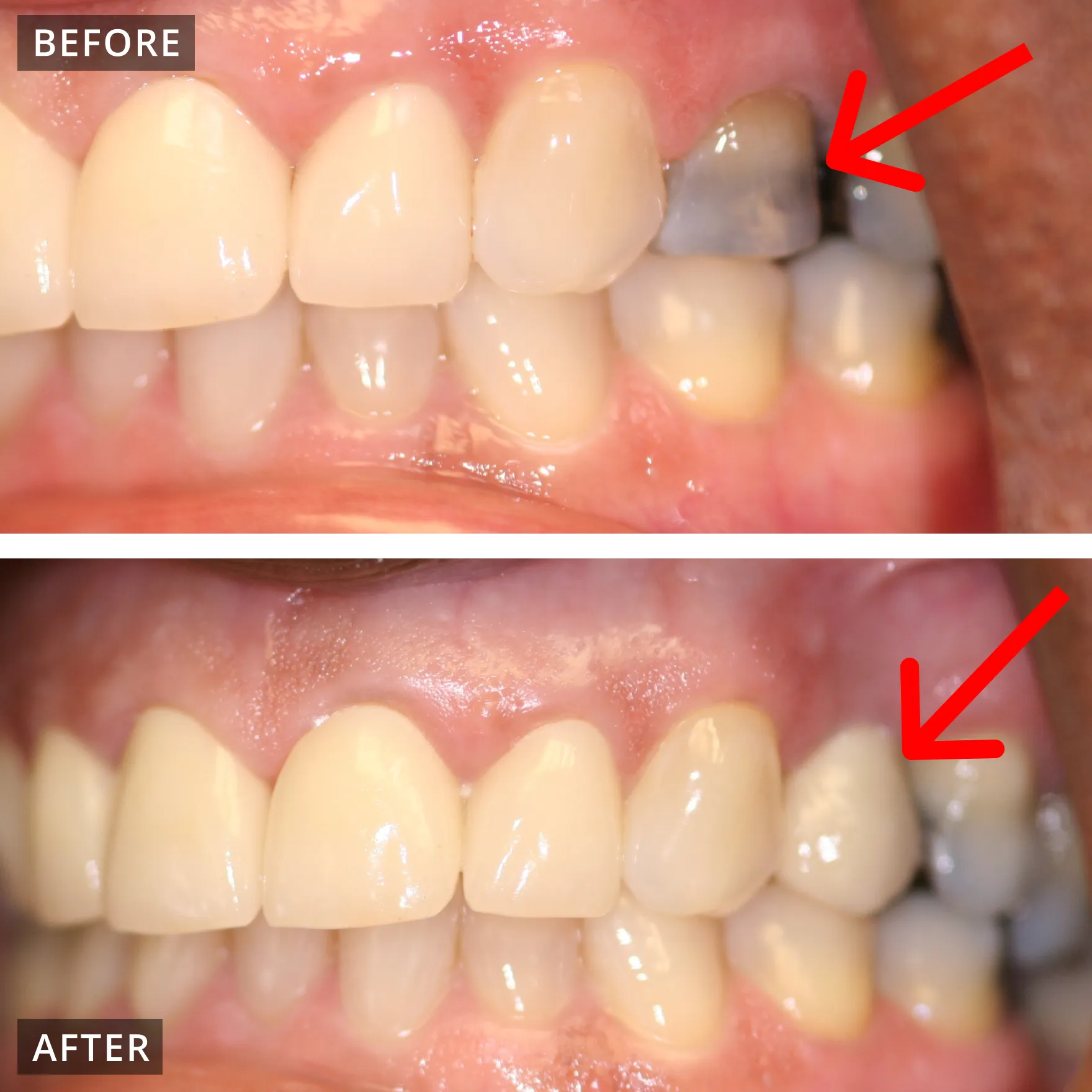 Single implant and front crowns