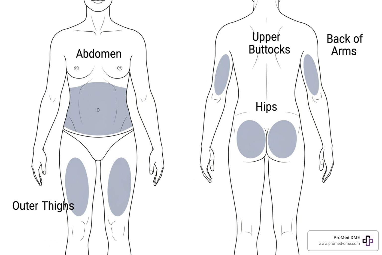 Diagram showing recommended body areas for infusion sets: abdomen, upper buttocks, hips, back of arms, outer thighs, with cross-hatching to indicate suitable areas - Insulin pump site rotation