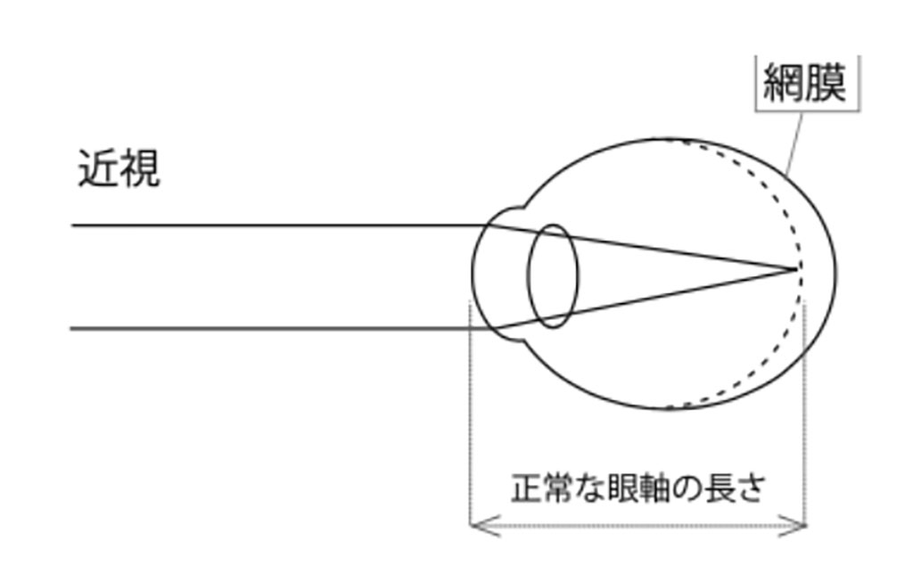 眼球の形が長くなり、ピントが網膜の手前になっている状態（日本眼科医会HP「目についての健康情報」から）