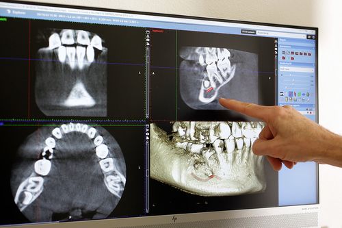 Endodonzia e trattamento endodontico: le cose da sapere