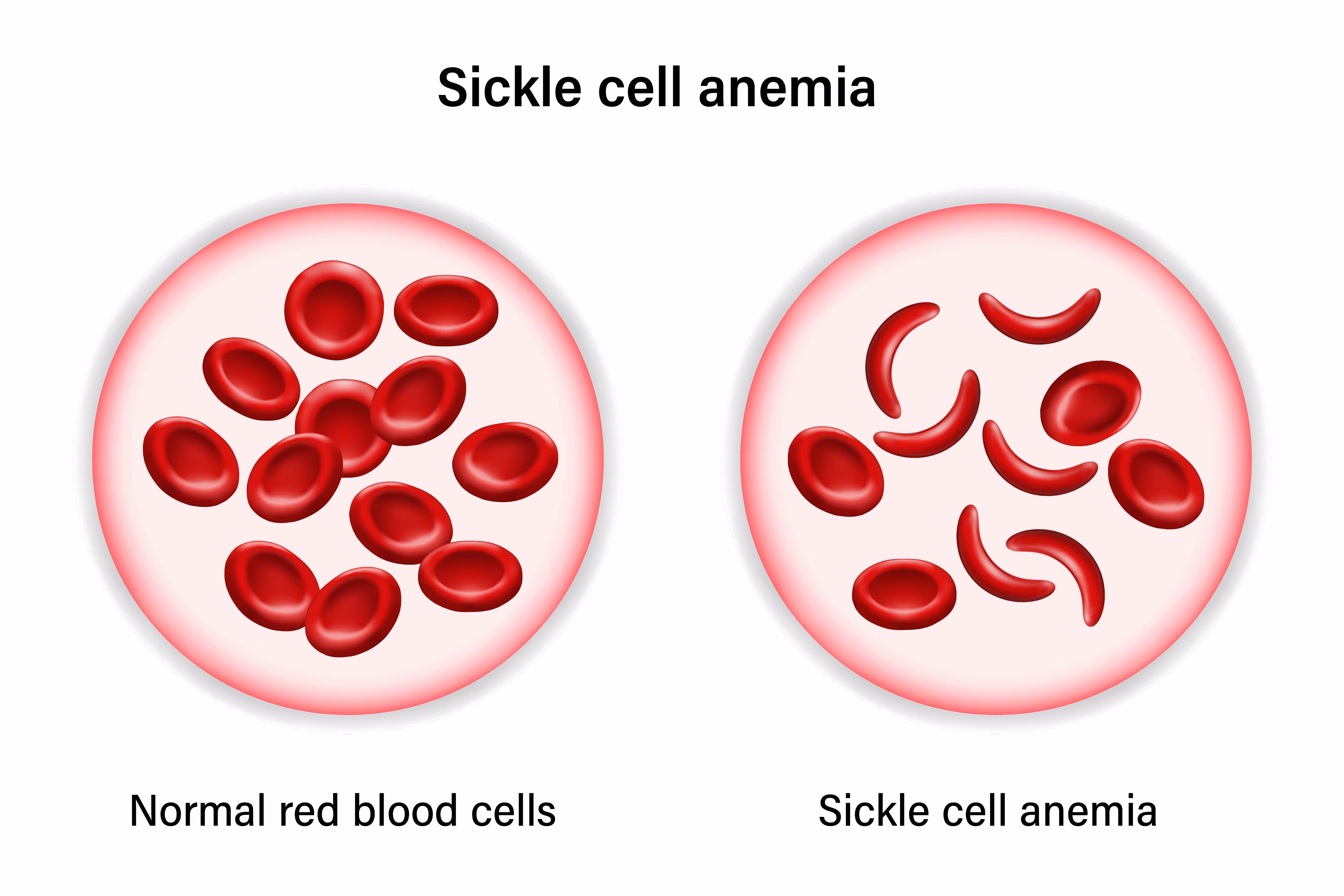 Illustration showcasing normal red blood cells in comparison to sickle cell anemia. Photo credit: istock.com/Rujirat Boonyong.