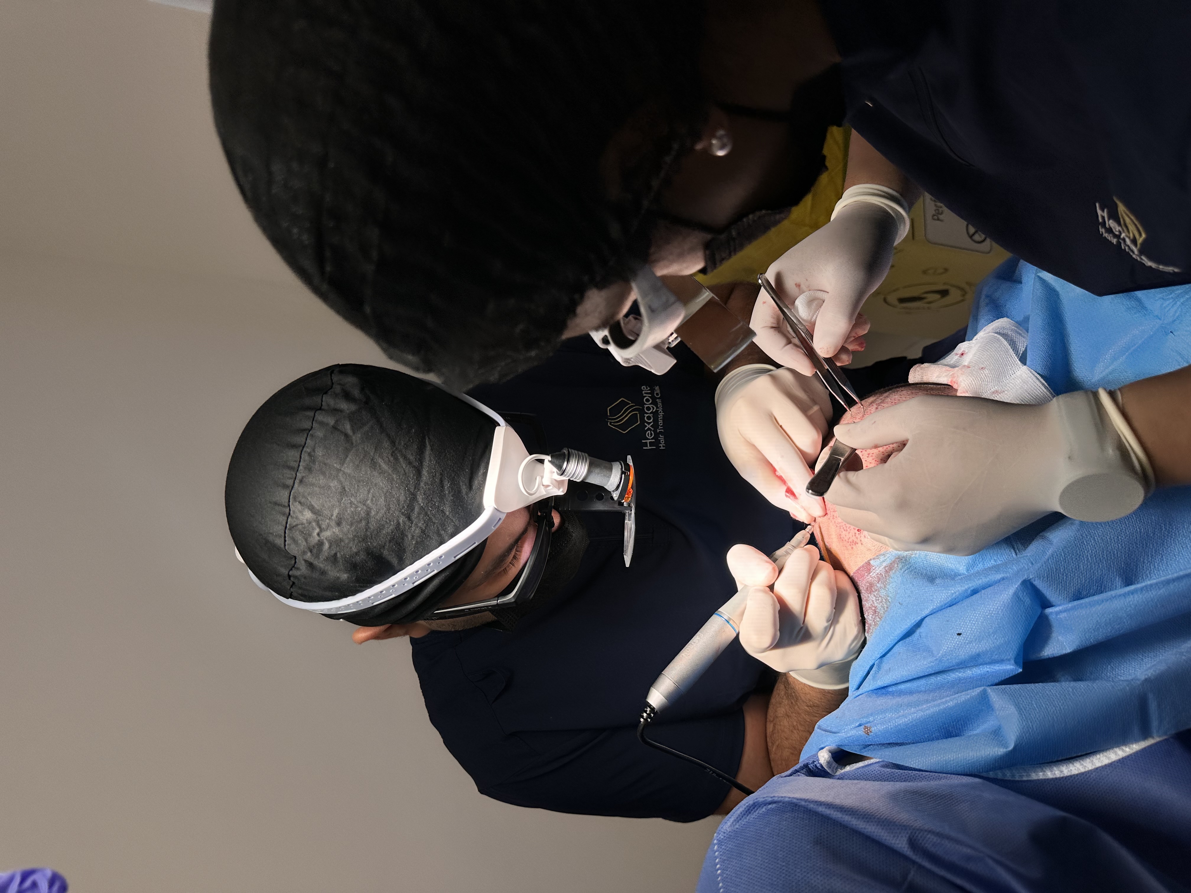 Combien de temps dure une greffe de cheveux ?