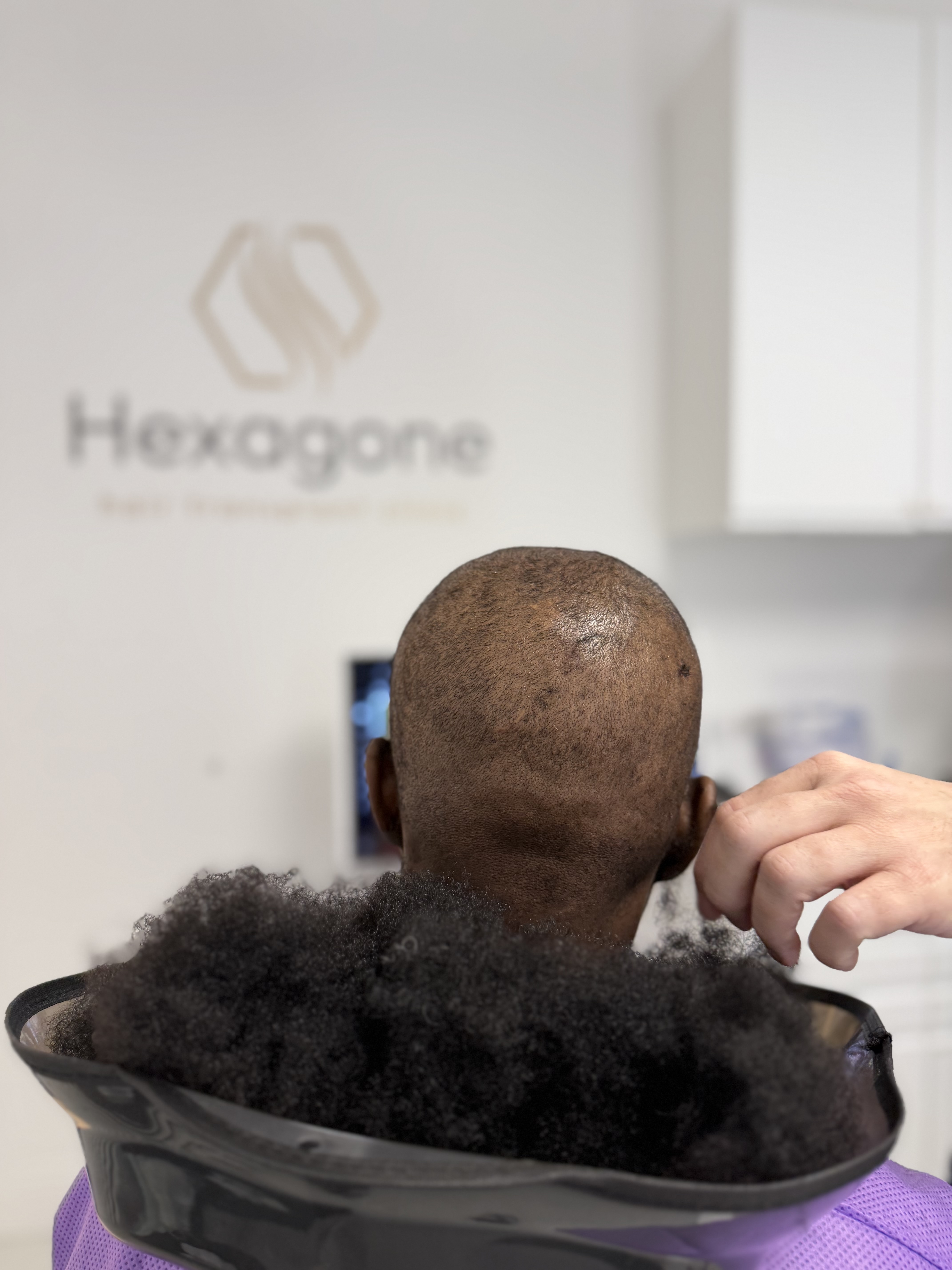 Comprendre l’alopécie chez les patients aux cheveux afro et les spécificités techniques