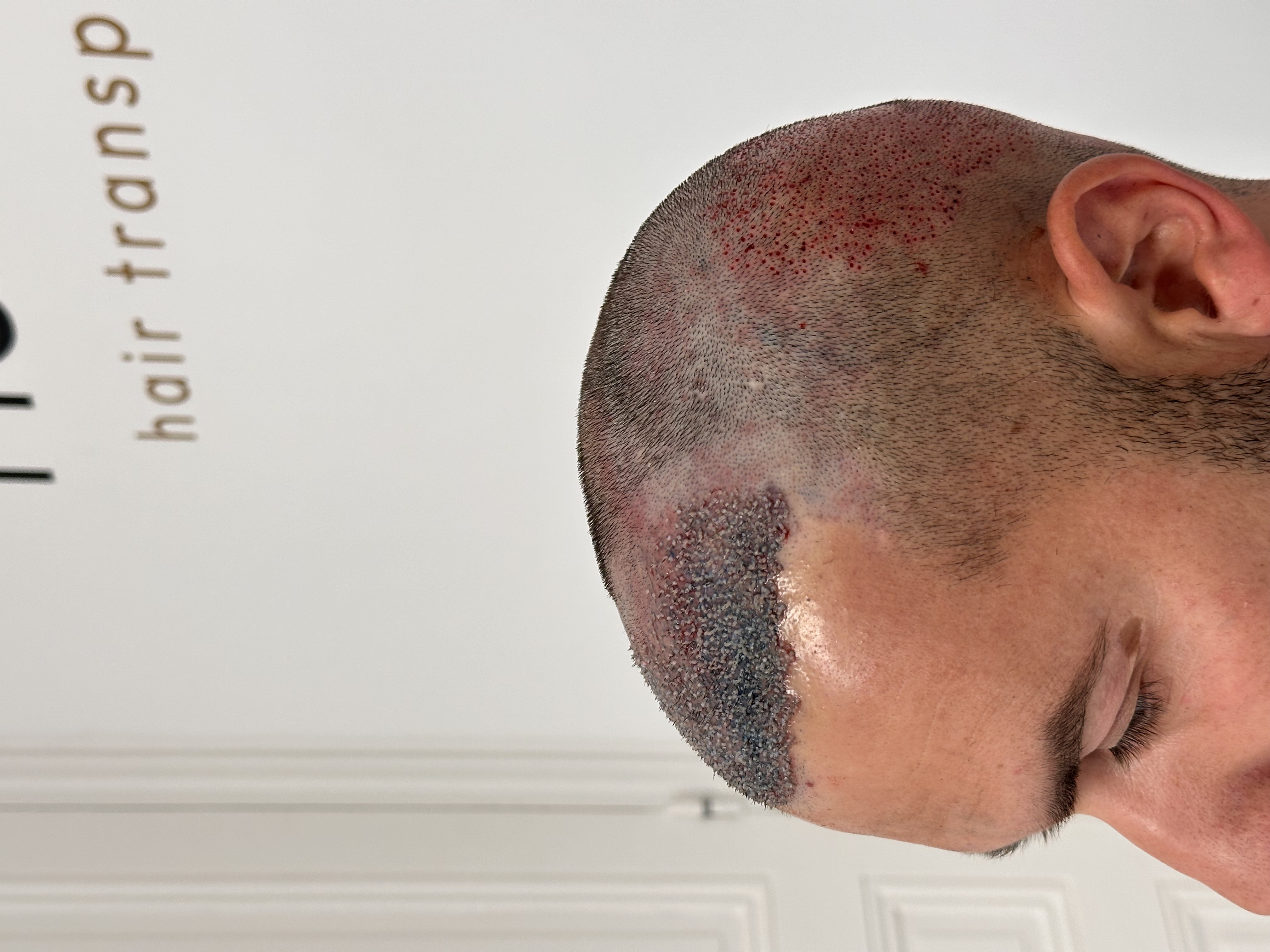 Pourquoi la ligne frontale est déterminante pour un résultat naturel ?