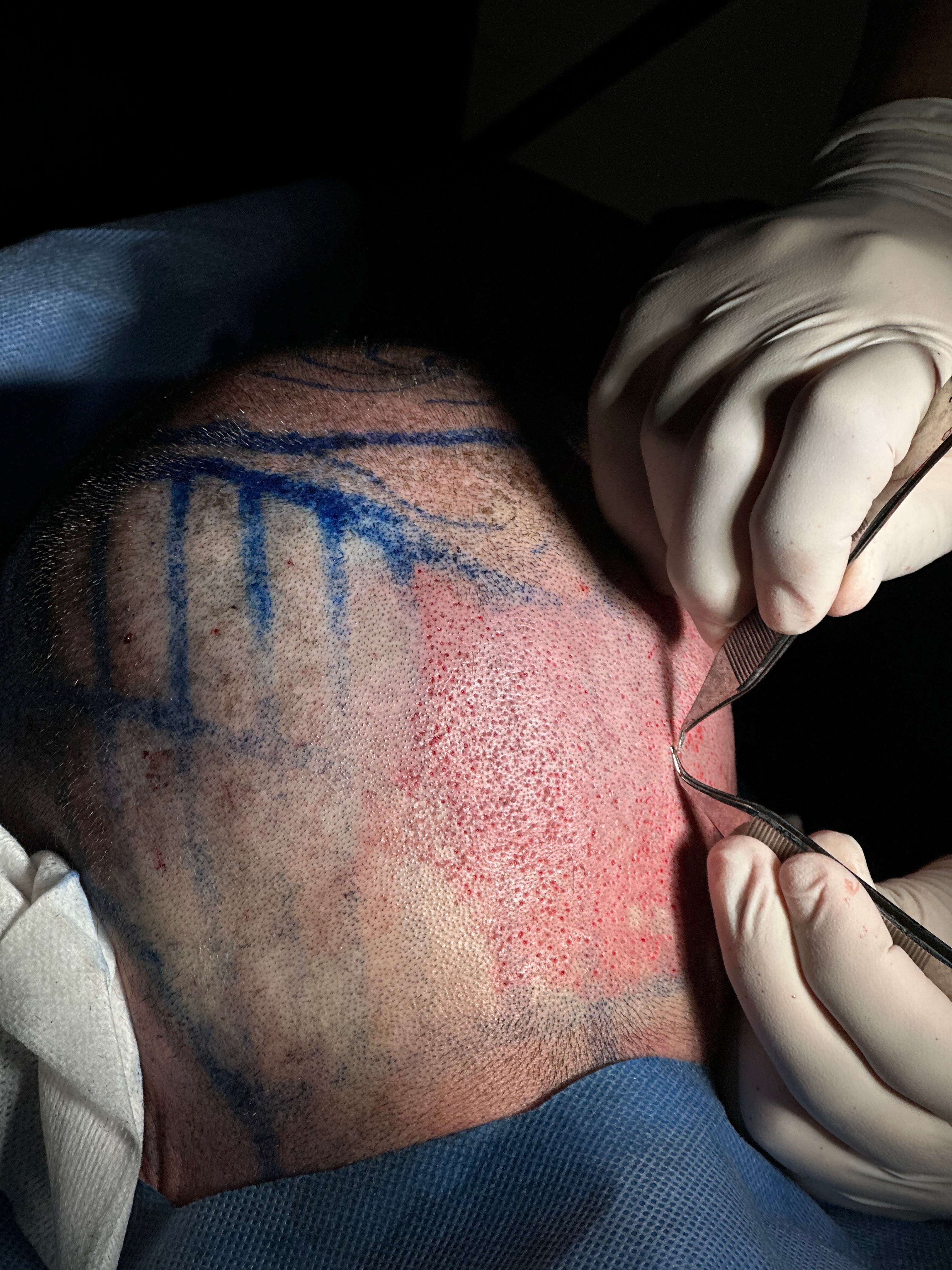 Comprendre la zone donneuse et son rôle dans une greffe de cheveux