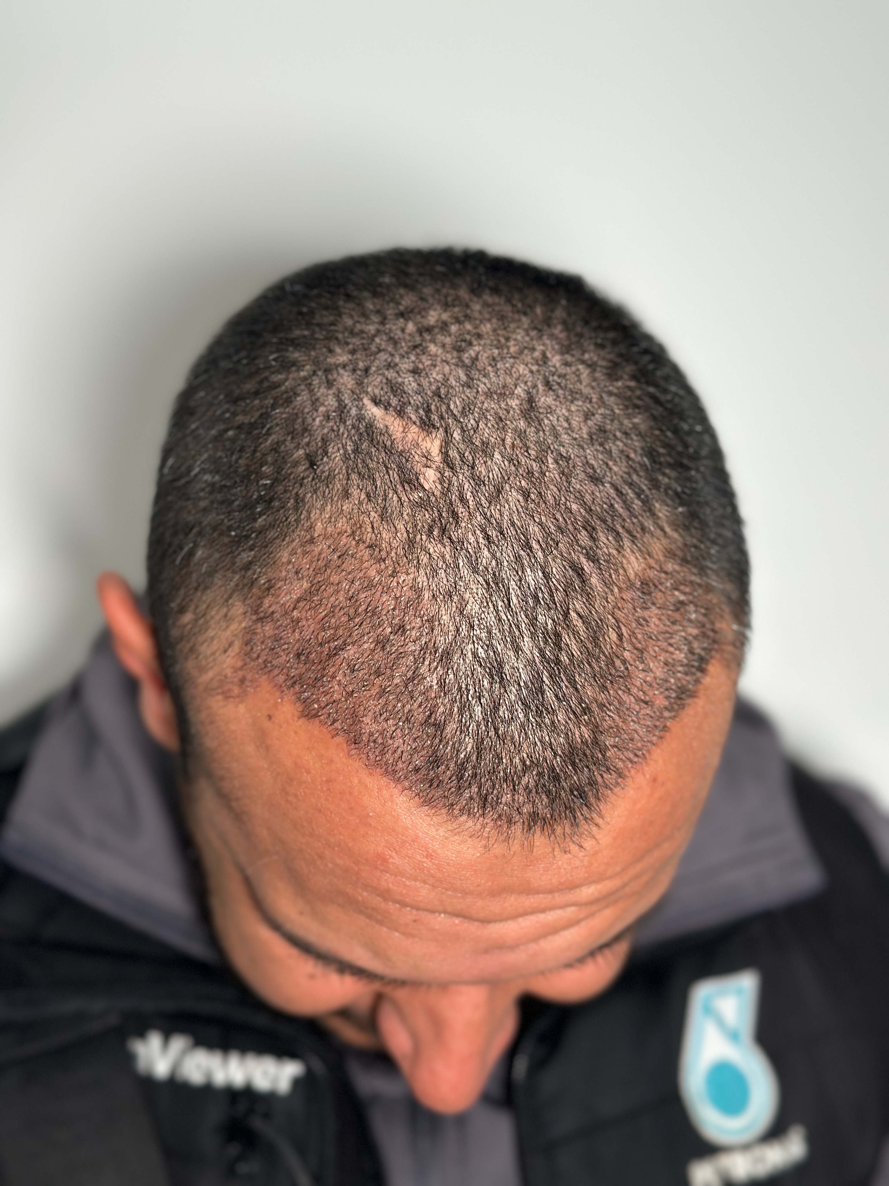 Peut-on perdre les cheveux greffés ?