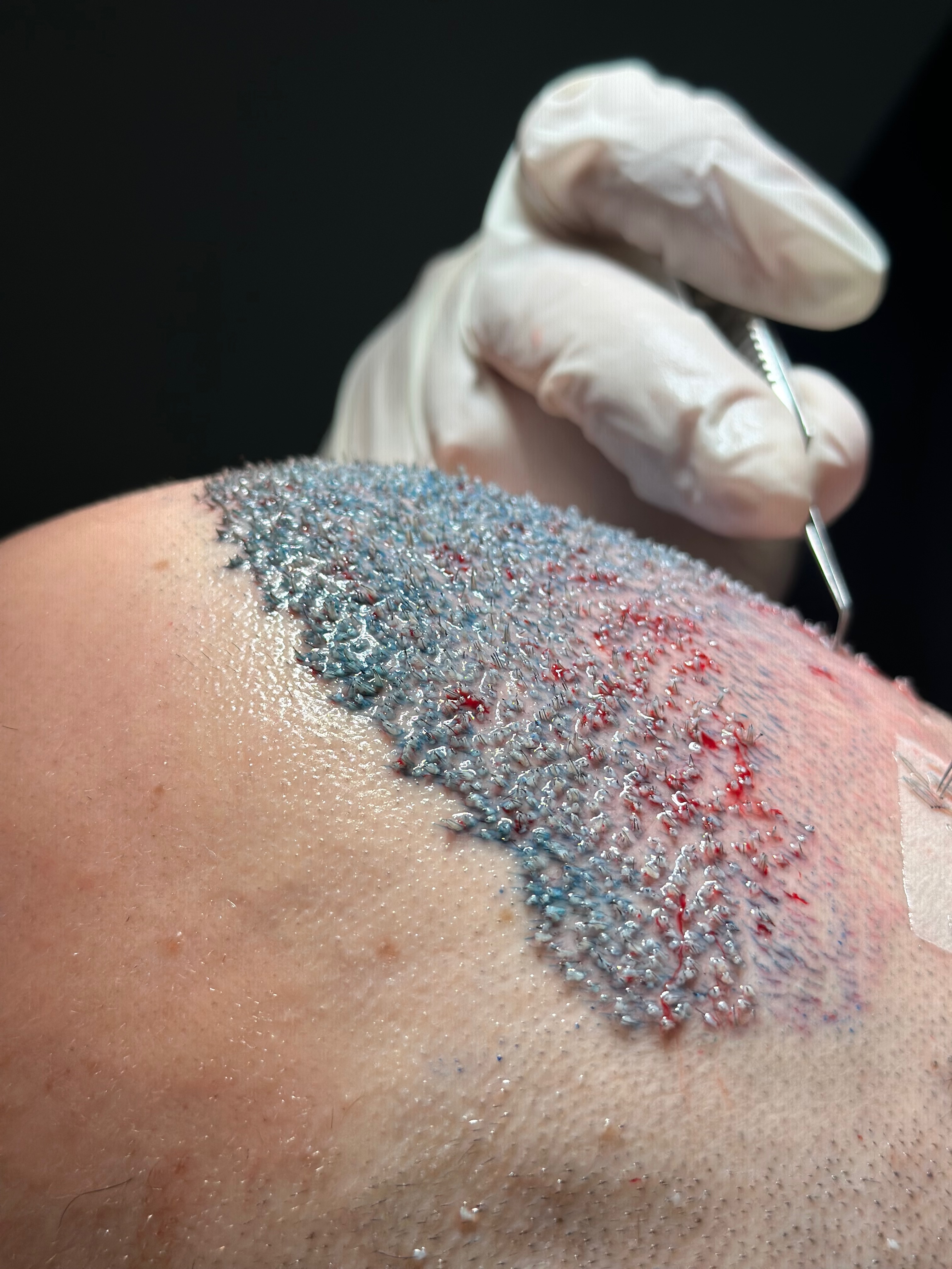 Combien de temps dure réellement une greffe de cheveux dans le temps ?