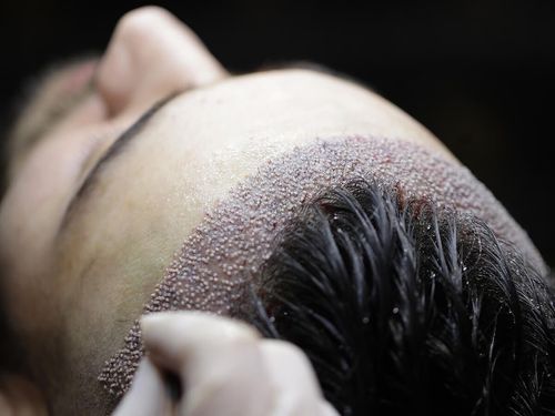 Hair transplant in Turkey: The real pitfalls
