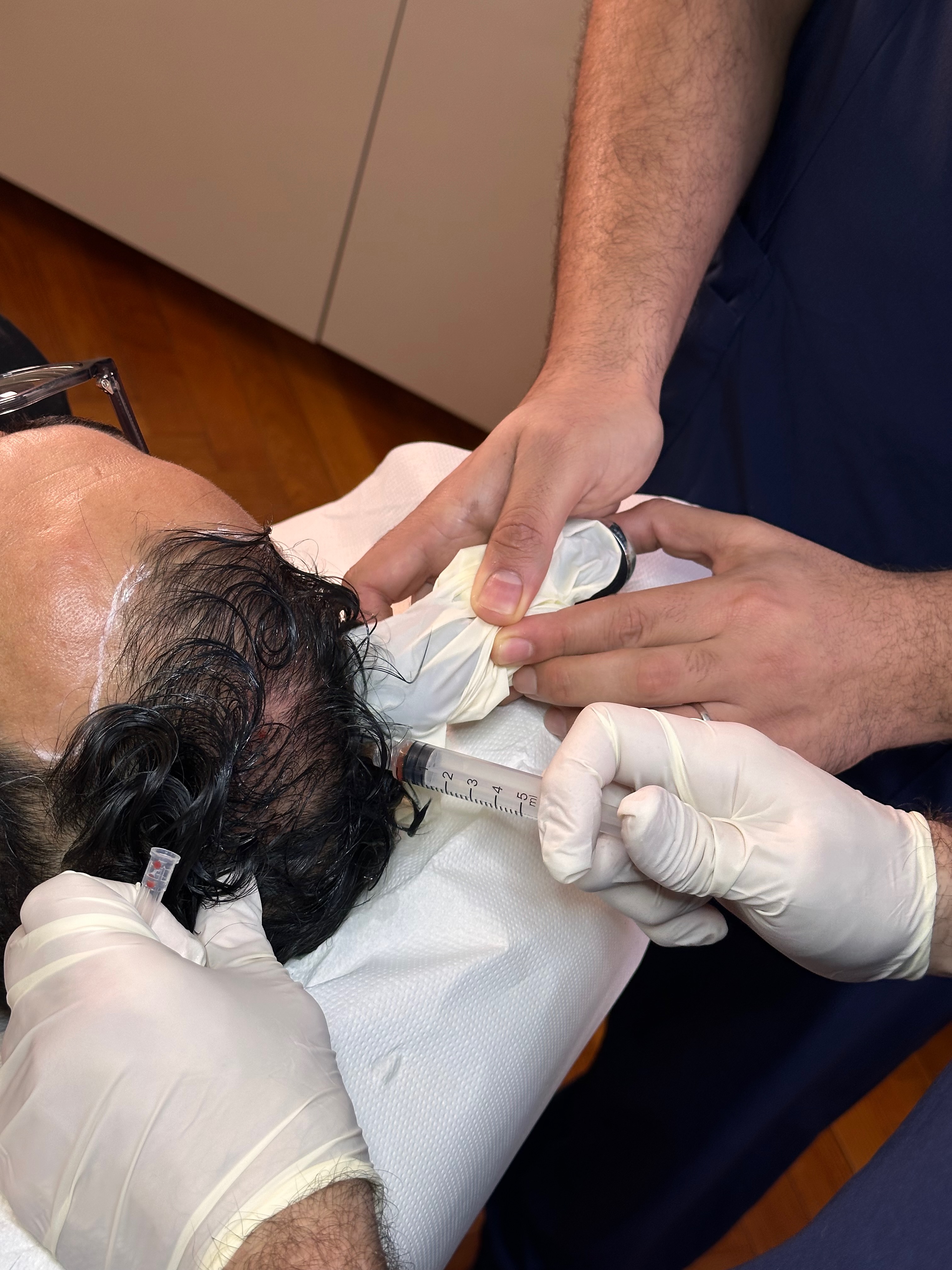PRP and hair transplant in Nice: why is this treatment increasingly used as a complement?