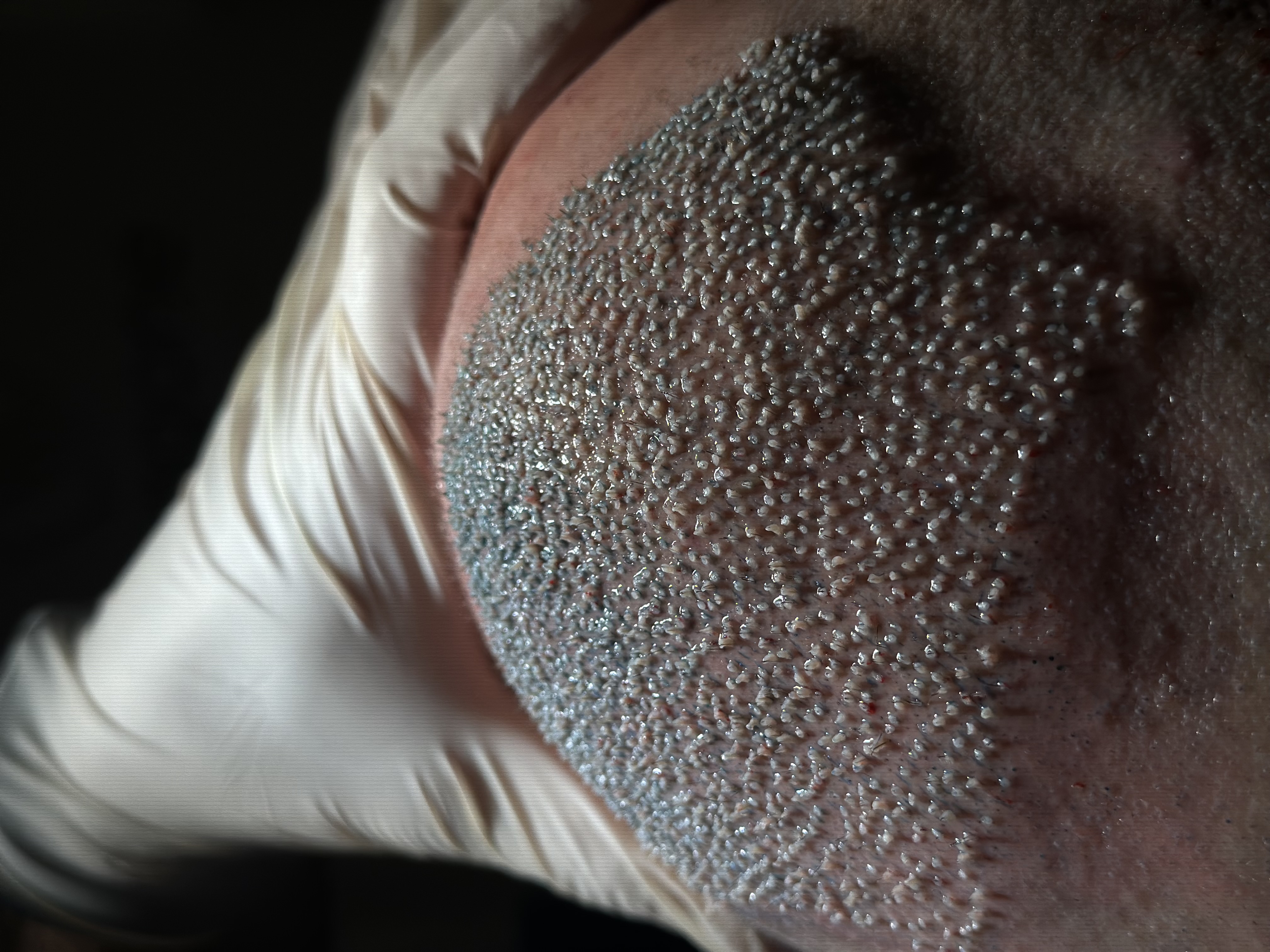 Hair Transplant in Nice in Summer: Should you avoid the pool and the sea after the procedure?