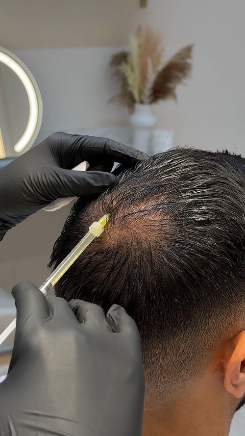 PRP capillaire et greffe de cheveux : peut-il vraiment faire repousser les cheveux ?