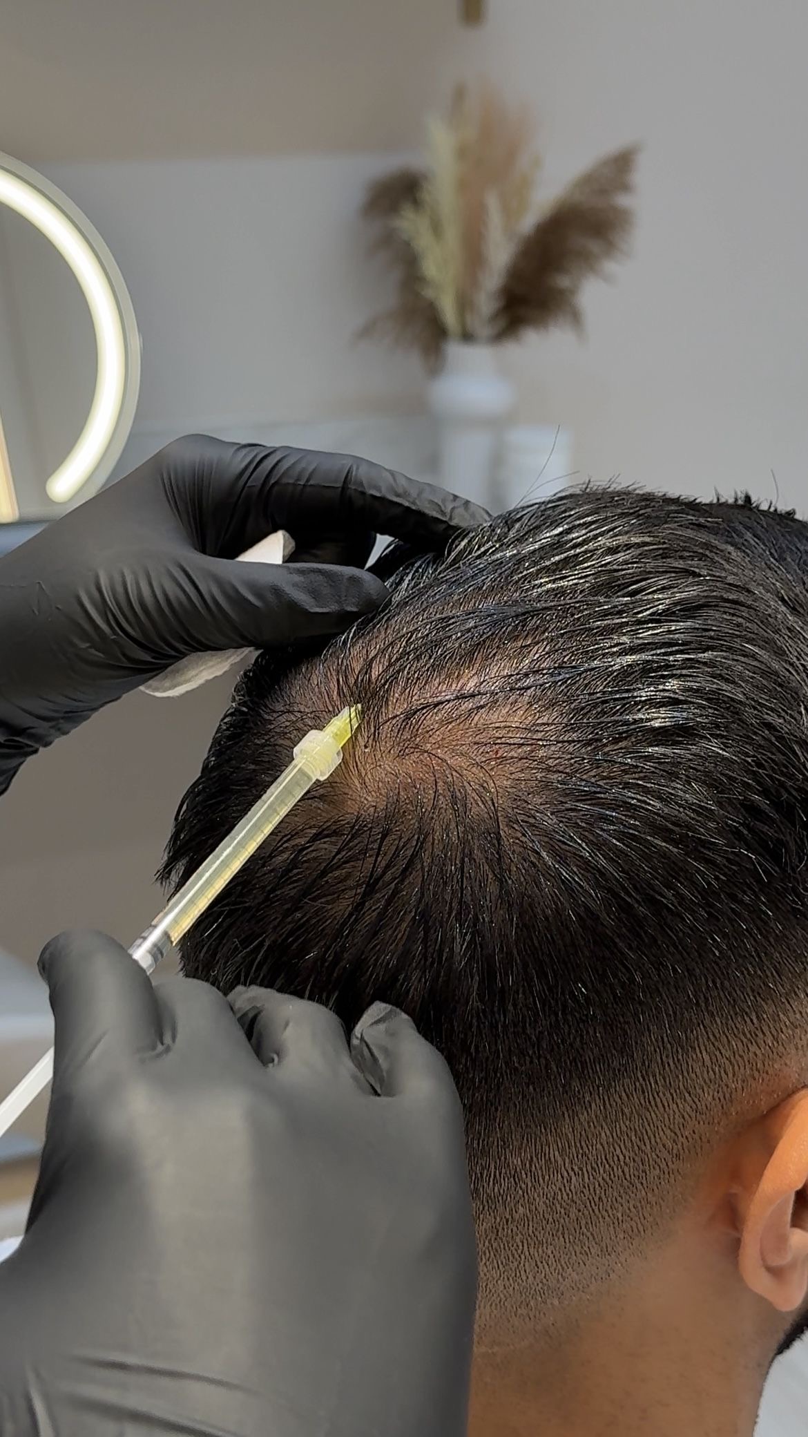 Hair PRP and Hair Transplant: Can It Really Regrow Hair ?
