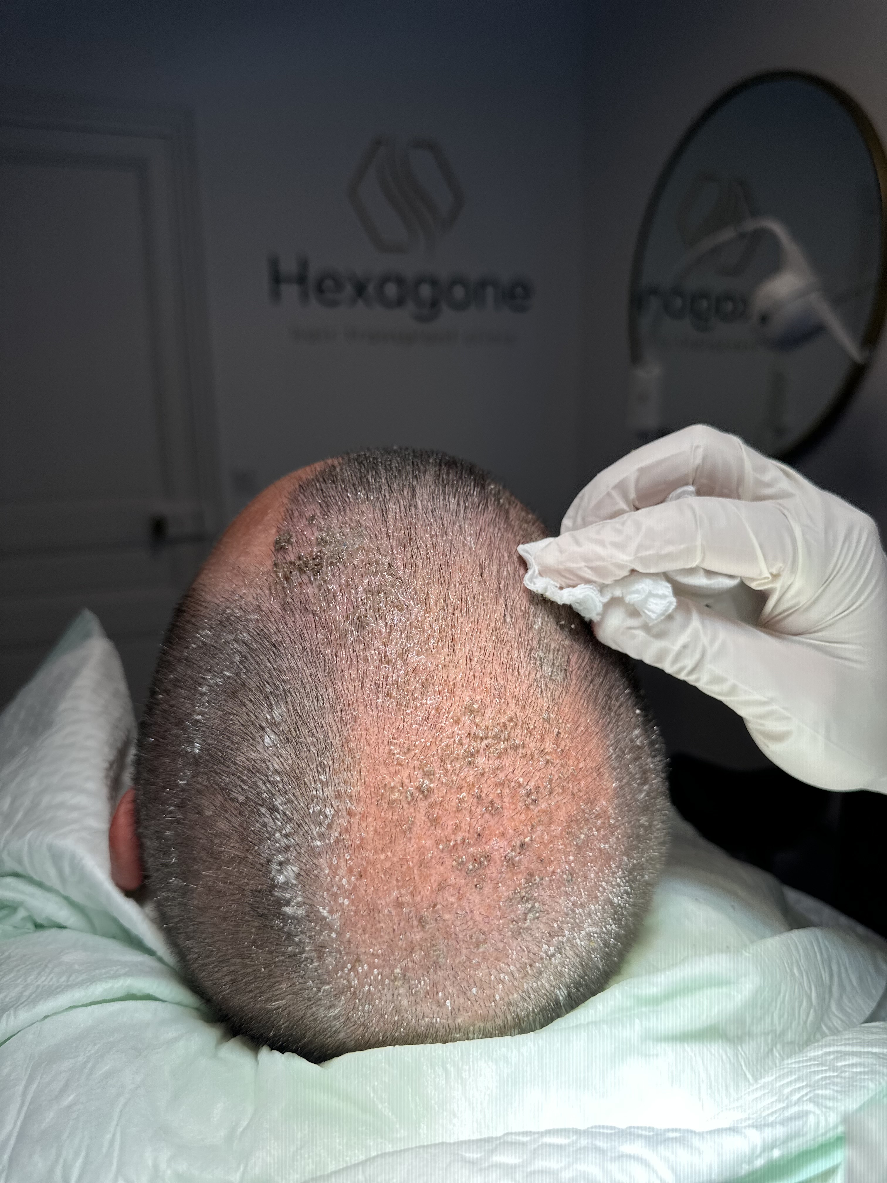 Shampoings anti-chute : peuvent-ils réellement ralentir la perte de cheveux ?