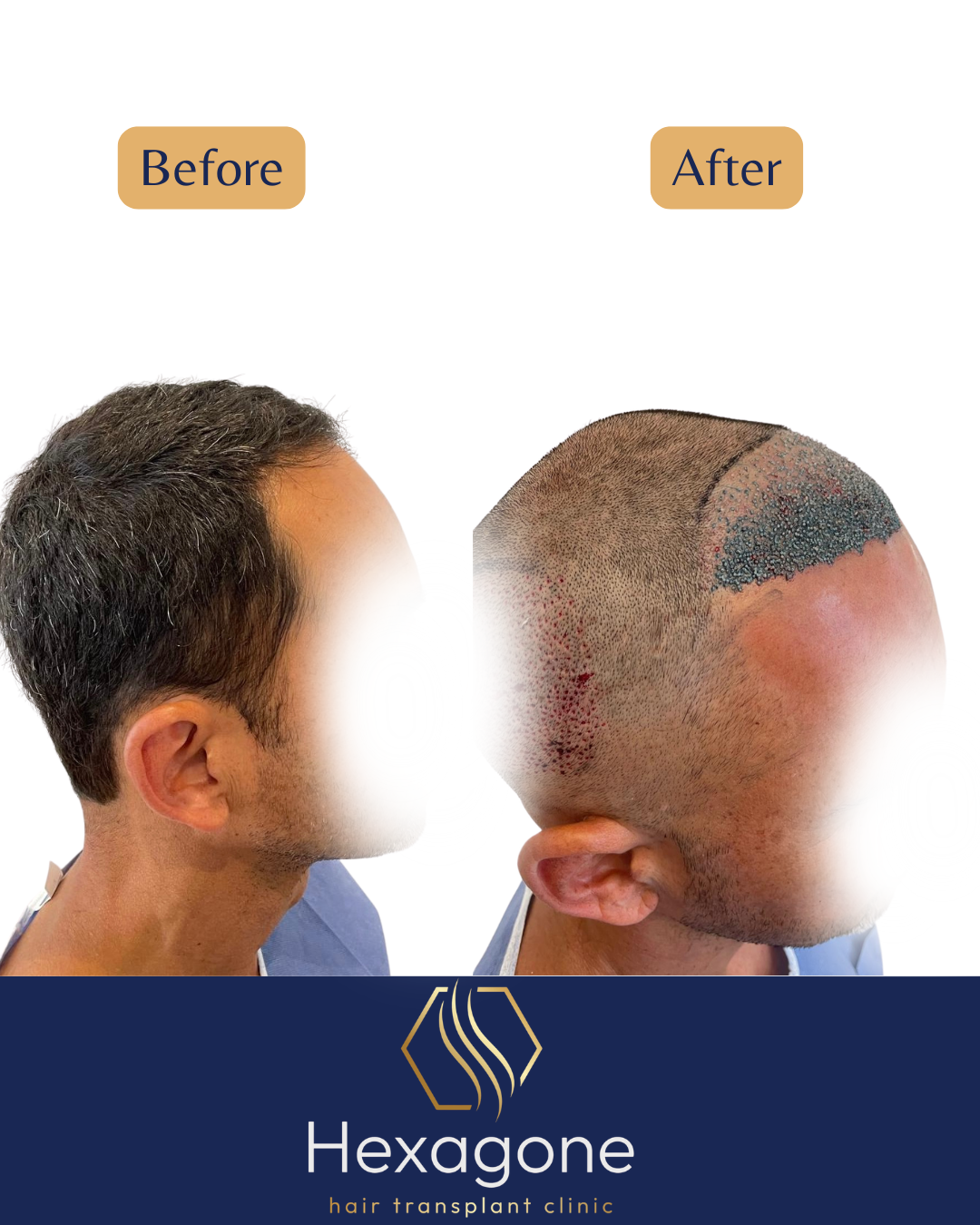 I still have hair: why am I still a candidate for a hair transplant?