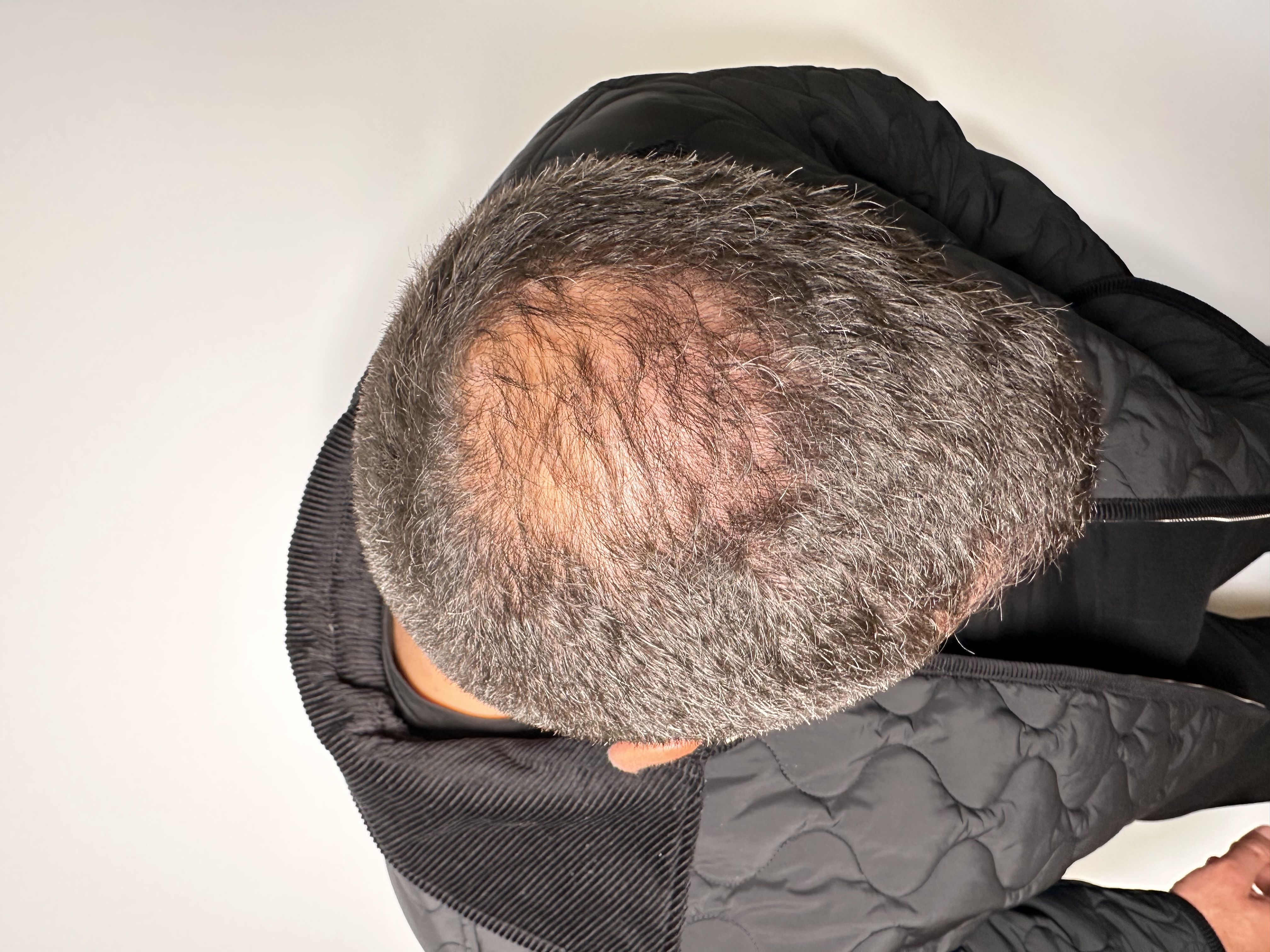 Why is the crown the most difficult area to treat in hair transplantation?