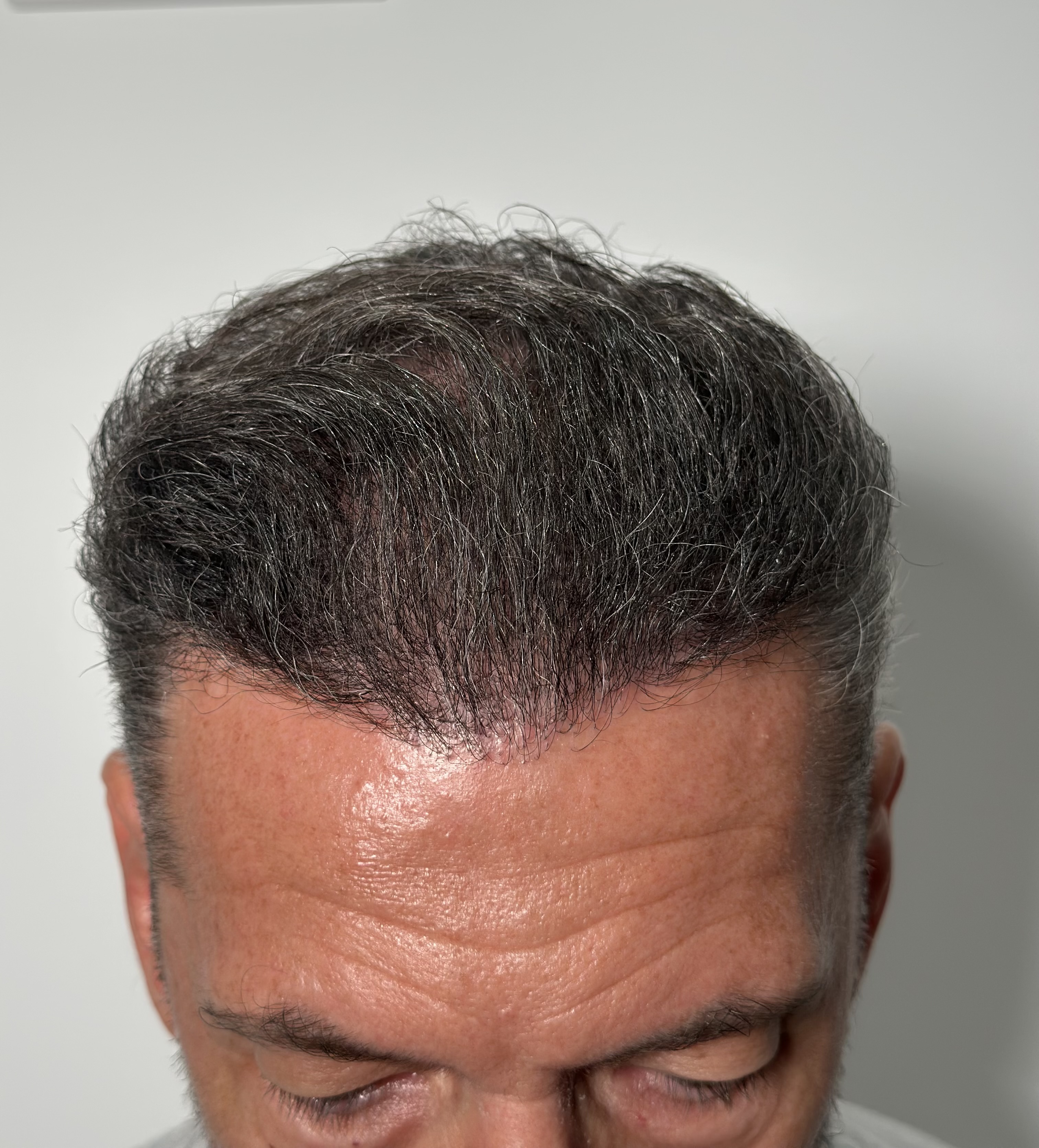 Greffe de cheveux ratée : causes fréquentes et solutions de correction