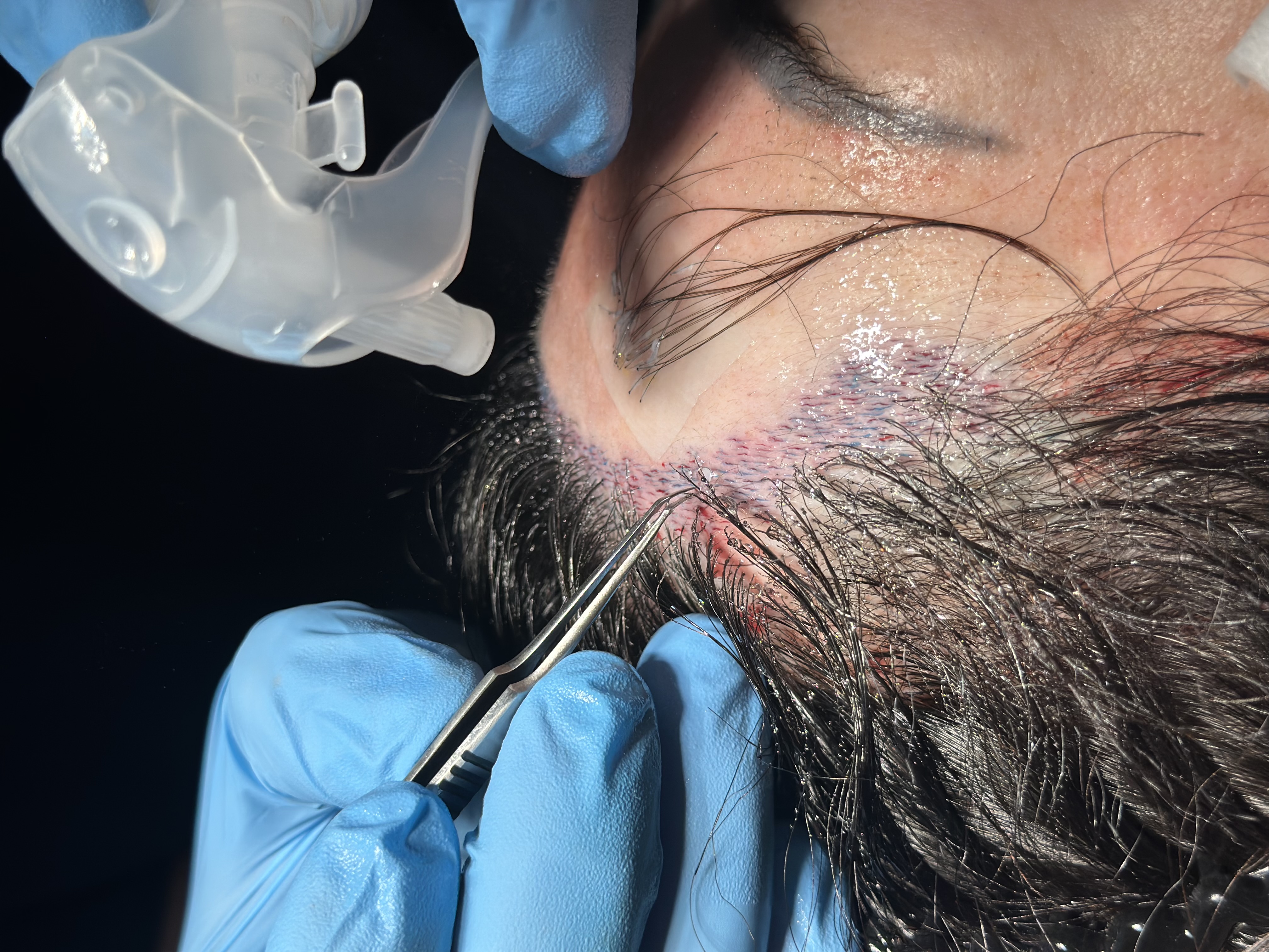 FUE Saphir vs DHI : quelle technique de greffe de cheveux choisir ?