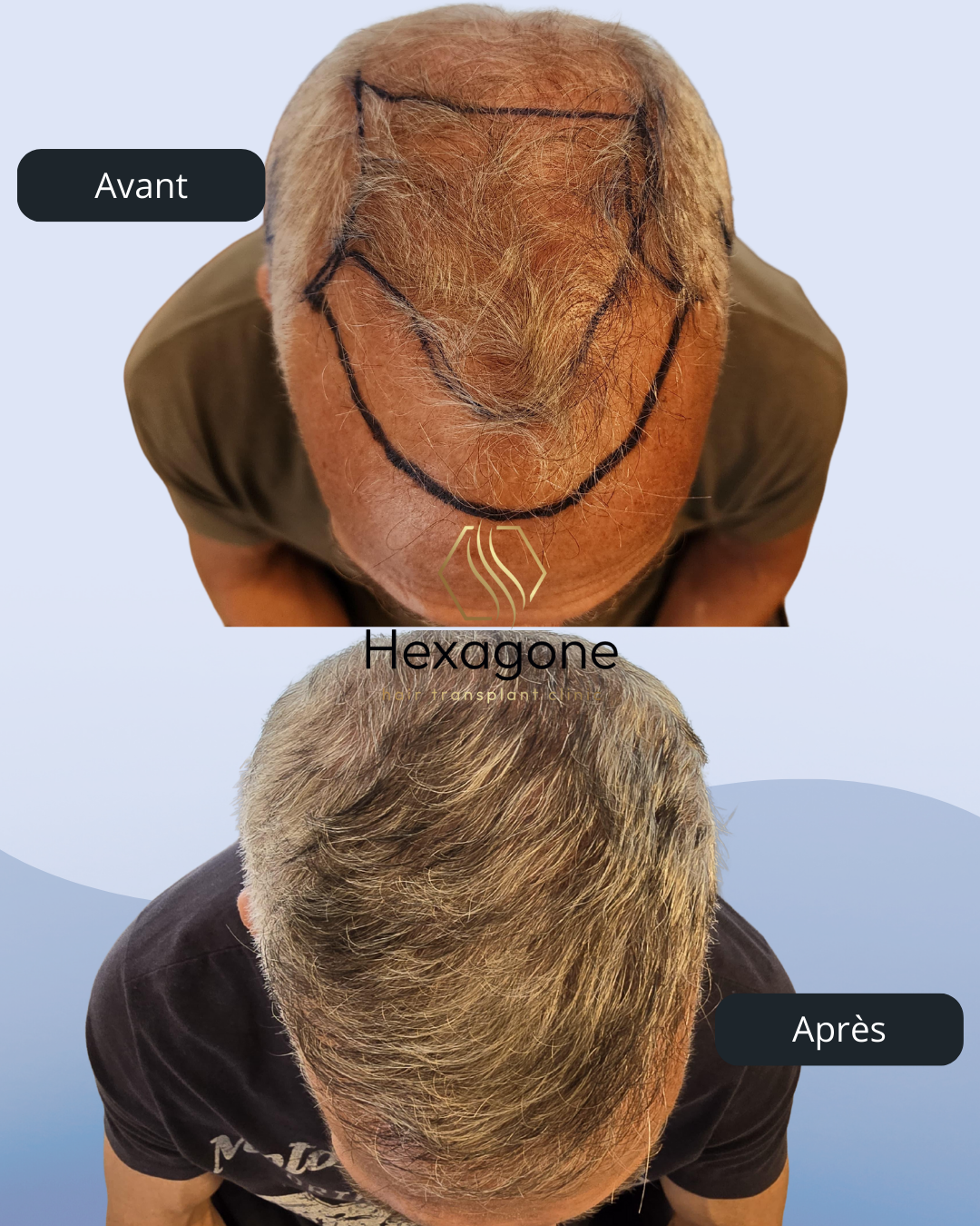 Greffe de cheveux en France ou en Suisse : Pourquoi les Suisses choisissent Nice ?