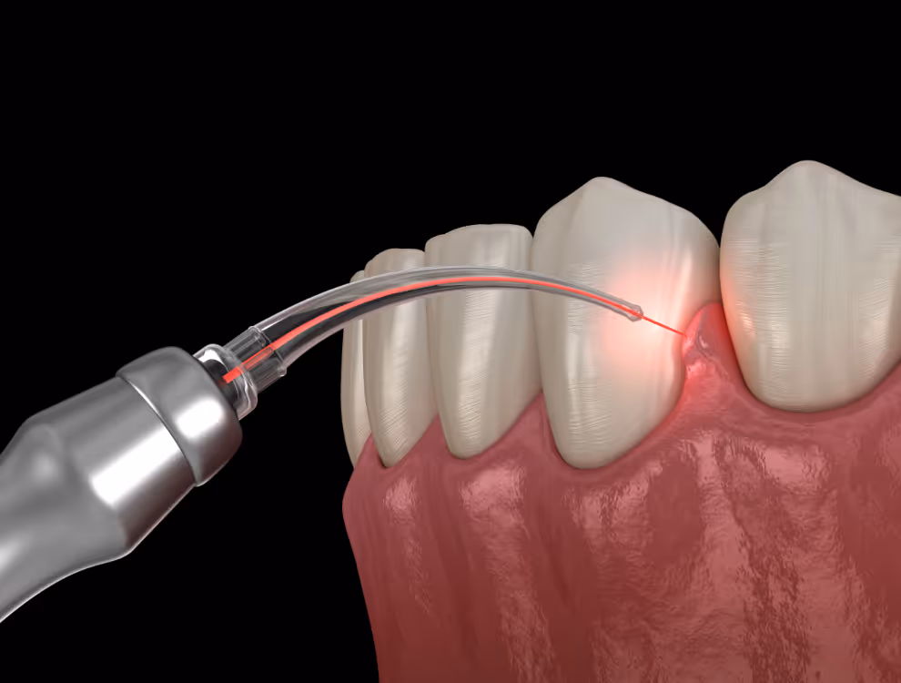 How Is Laser Dentistry Used in Modern Dental Practices?
