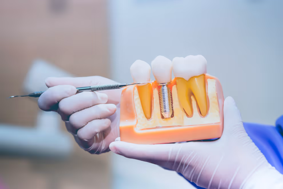 Which Is Better for a Missing Tooth: A Dental Bridge or an Implant?