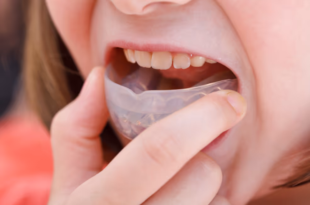 Is a Custom Mouthguard Better Than a Store-Bought "Boil-and-Bite" Guard?
