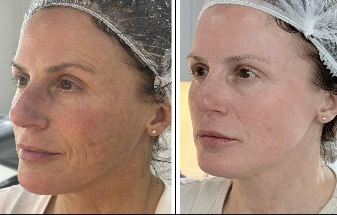 Plasma Skin Tightening