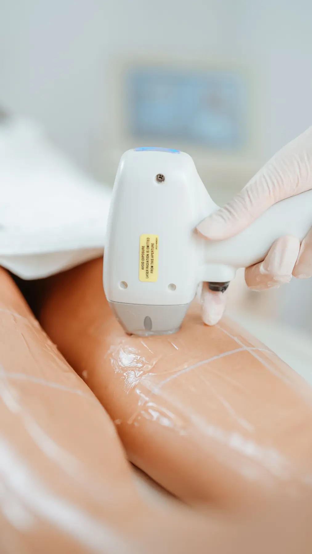 Laser Hair Removal with Soprano ICE