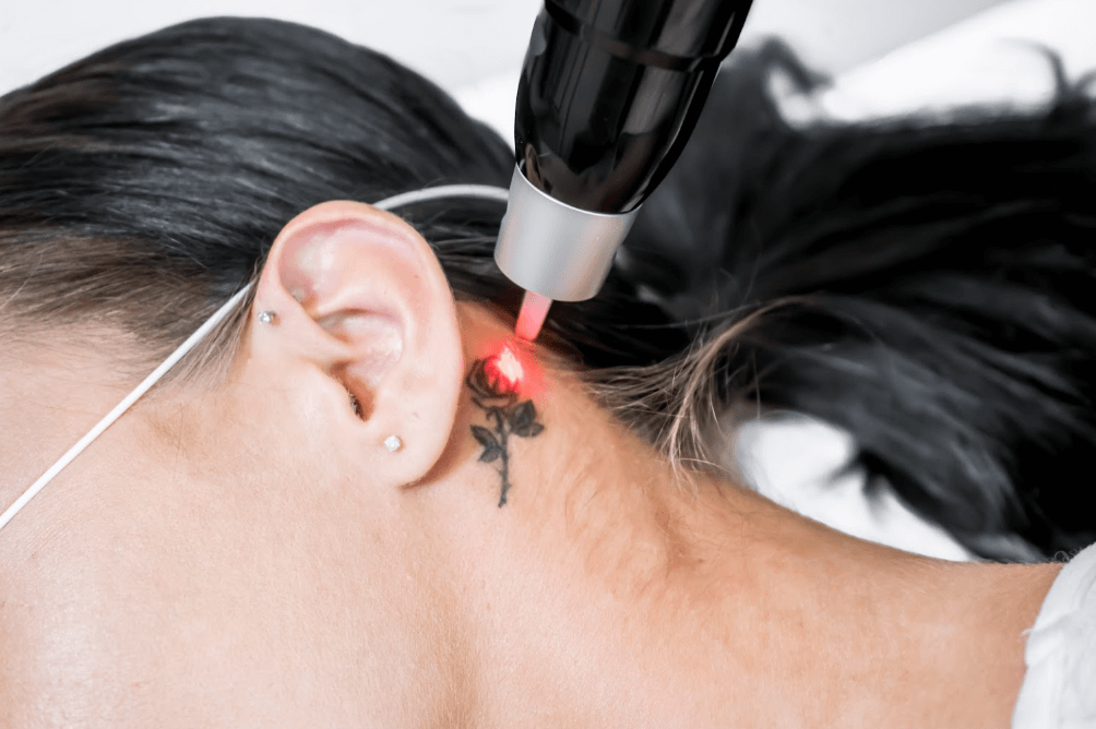Laser tattoo-removal treatment planning for different body areas in Mukilteo, Washington.