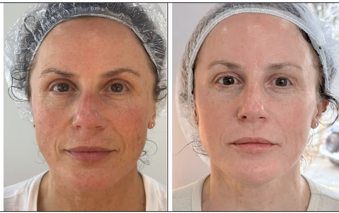 Real Hagen Health patient before and after Opus Plasma RF skin resurfacing for visible skin laxity