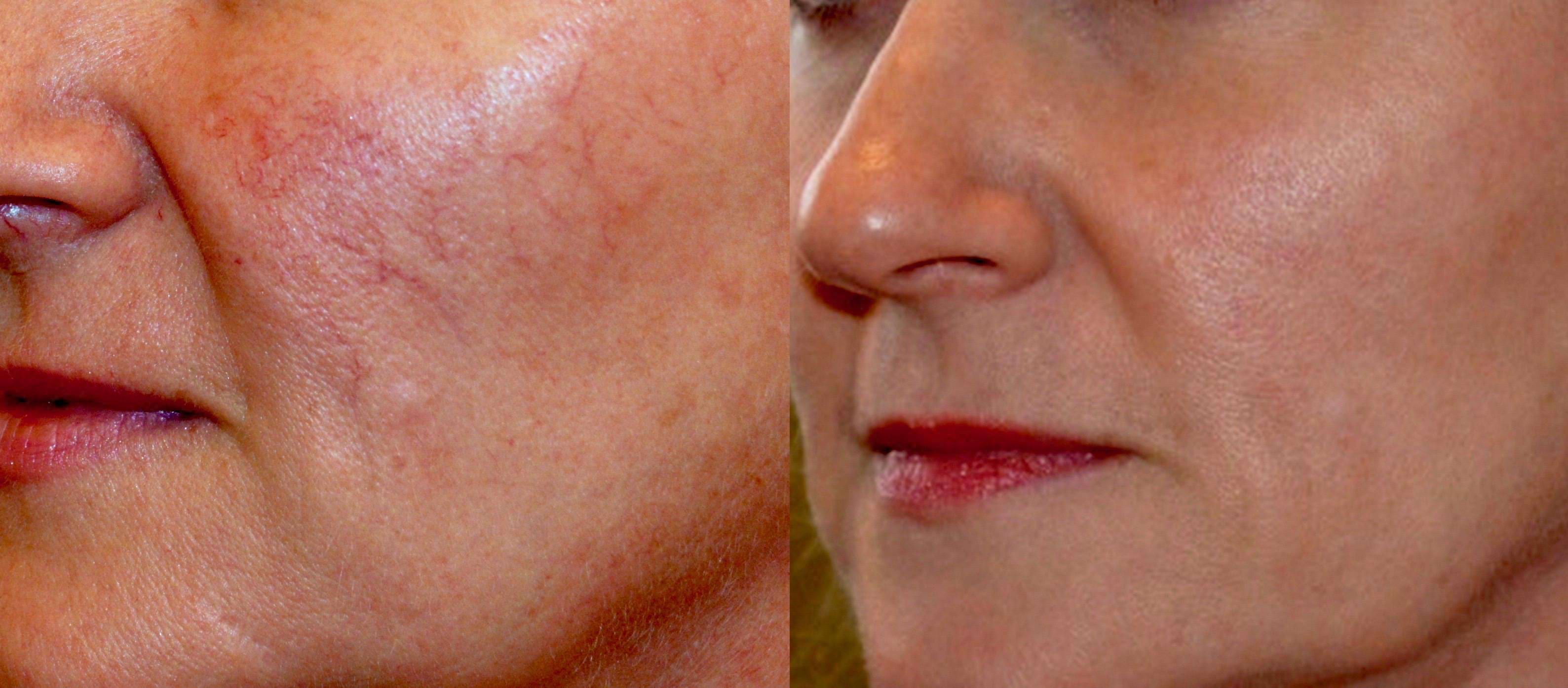 Before and after IPL treatment showing reduced facial redness