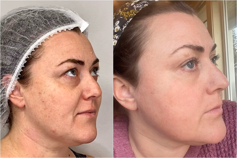 Real Hagen Health patient before and after IPL treatment showing improvement in facial pigmentation