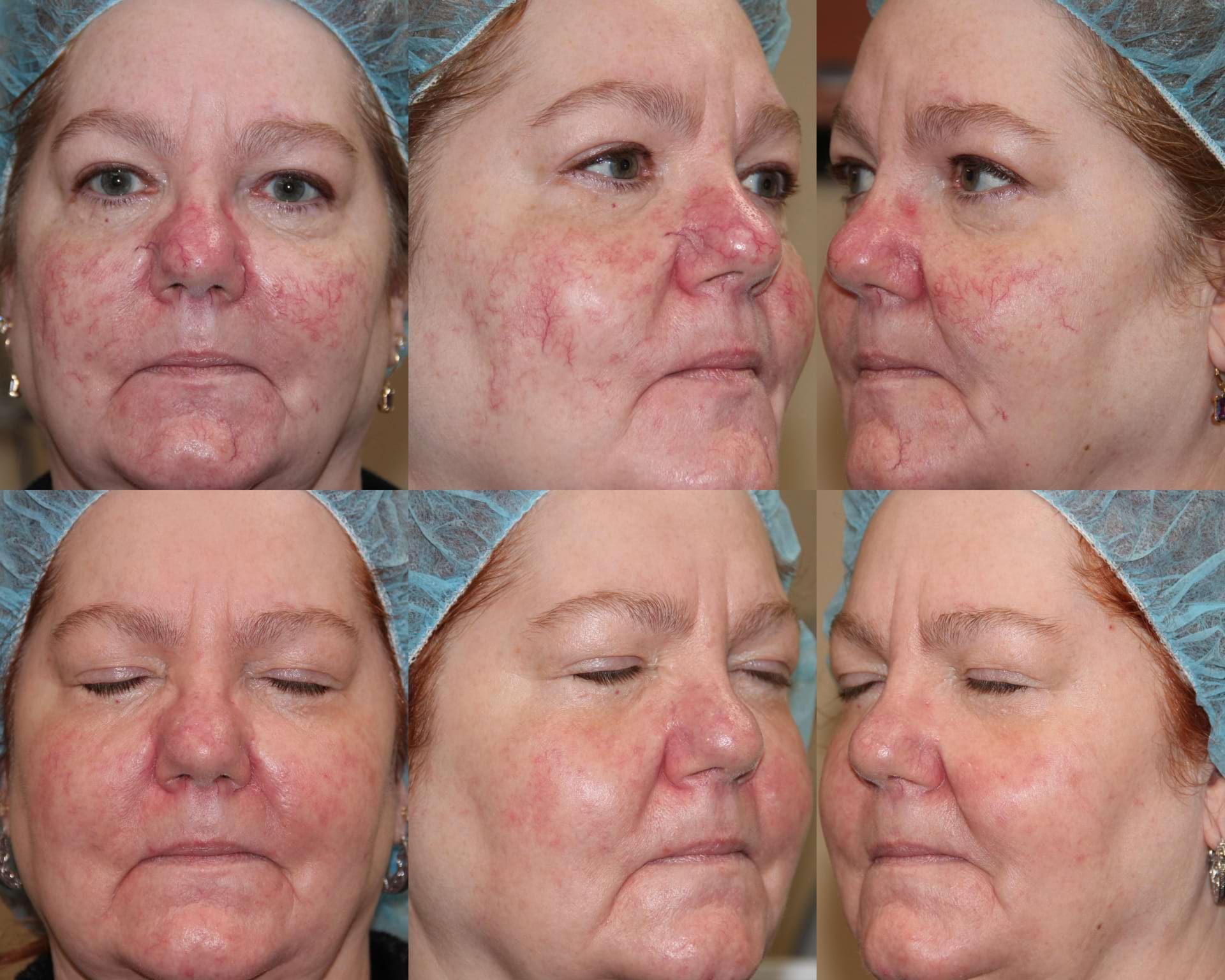 Real Hagen Health patient before and after IPL treatment for rosacea-related facial redness