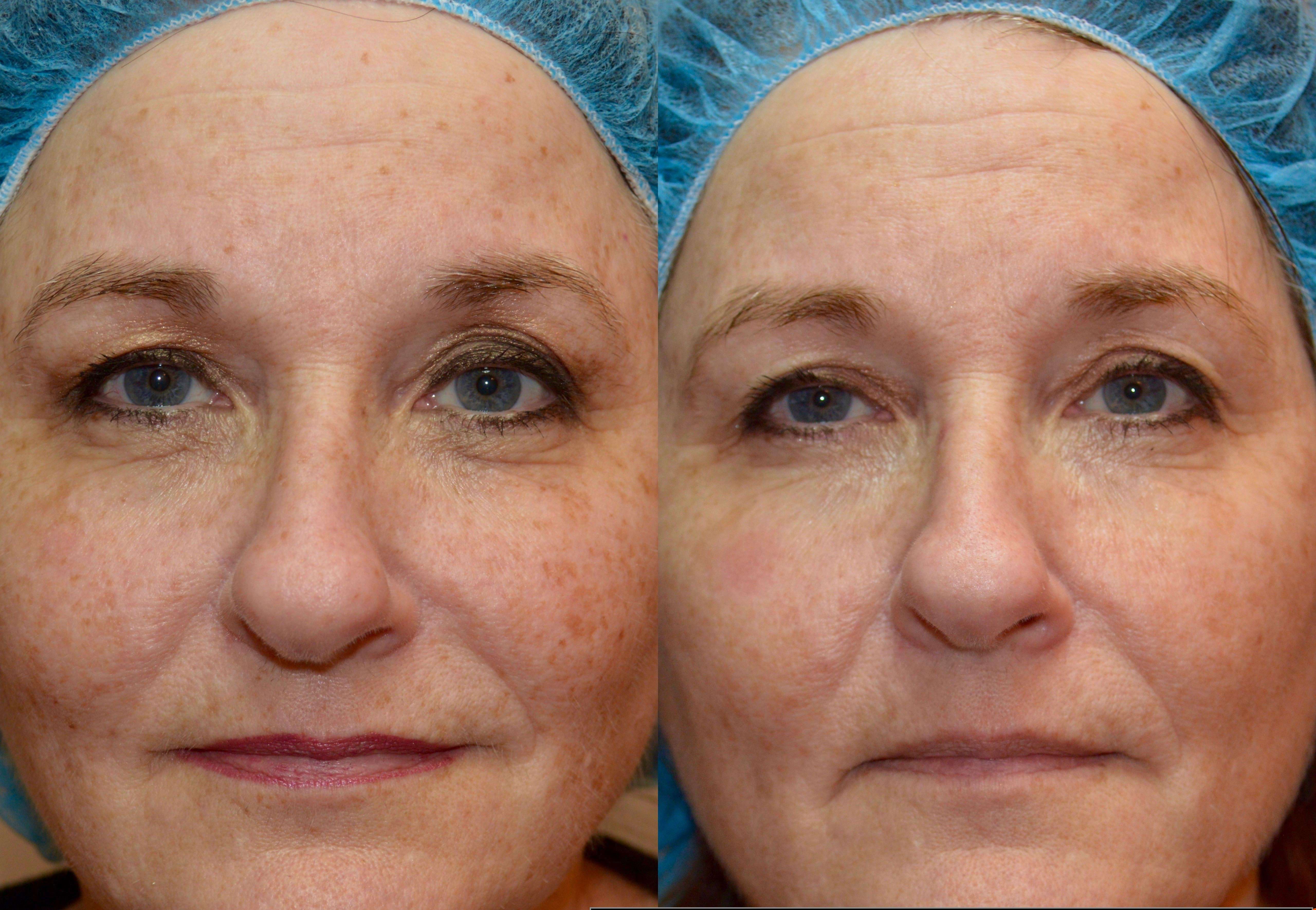 Before and after IPL photofacial treatment showing reduced visible sun damage