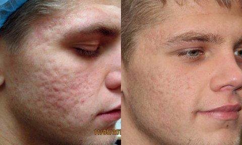 OPUS Plasma — Scars, Texture & Fine Lines