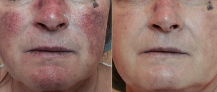 IPL photofacial before-and-after results for redness and pigmentation treatment in Mukilteo, Washington.