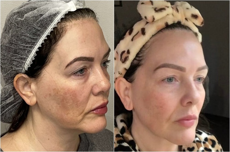 Before and after OPUS Plasma skin resurfacing showing improvement in tone and texture