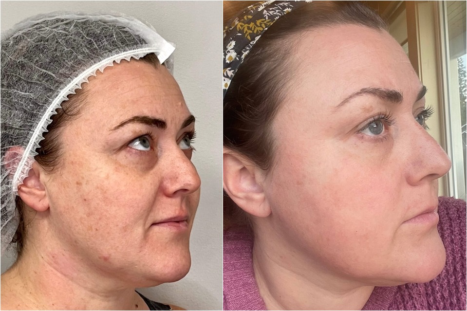 OPUS Plasma — Sun Damage & Skin Renewal